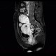 Mixed adenoneuroendocrine tumour of appendix, mixed tumour, hydronephrosis, ascites: MRI - Magnetic Resonance Imaging